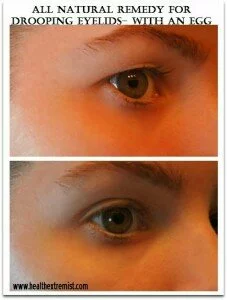 Natural Remedy For Drooping Eyelids, Sagging Eyelids Or Hooded Eyes