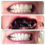 Whiten Your Teeth With This One Ingredient (Amazing Before & After Results)