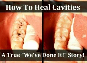 How To Heal Cavities (A True “We’ve Done It” Story)